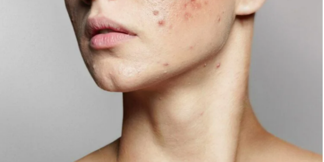 7 Things That Clog Your Pores And Cause Acne