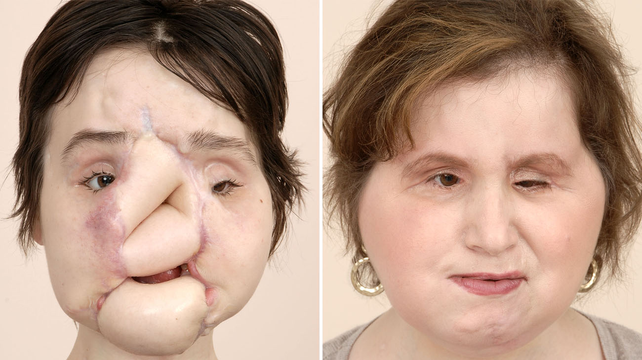 Road to Recovery: The youngest face transplant recipient in the United States is a woman…