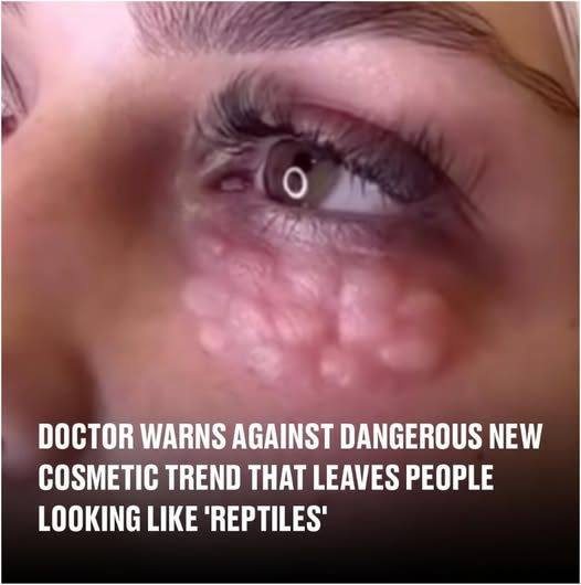 Doctor warns against dangerous new cosmetic trend that leaves people looking like ‘reptiles’