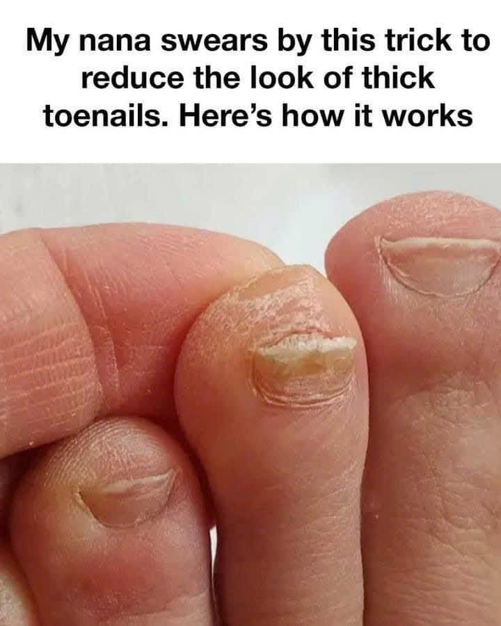 A Simple Method for Improving Thick Toenails